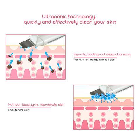 Ultrasonic Skin Scrubber – Facial Cleanser & Blackhead Remover with Vibration Massage (Ultrasound Peeling)